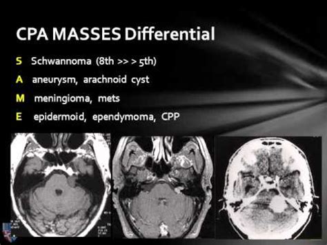 Cerebellopontine Angle Lesions - YouTube