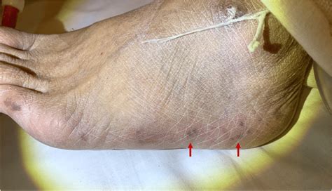 Palpable Purpura On The Left Dorsal Foot Arrow Download Scientific