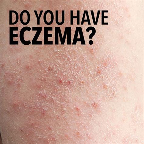 If You Have Dry Itchy And Rough Skin You May Have Eczema