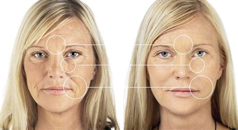 My lip size didn't fluctuate nearly as much as the first round of filler. Restylane Southington| Re:Nu 180 MedSpa | Re:nu 180 Medspa
