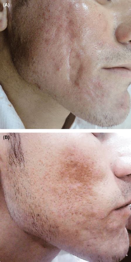A Male Patient With Grade 4 Acne Scars And Traumatic Scars In Group C