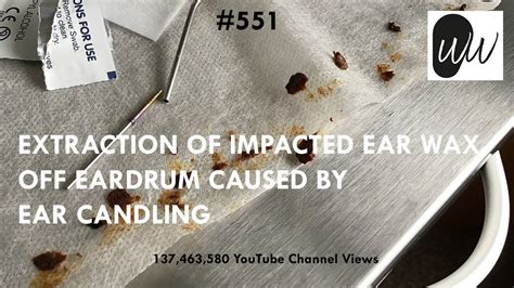 551 Extraction Of Impacted Ear Wax Off Eardrum Caused By Ear Candling