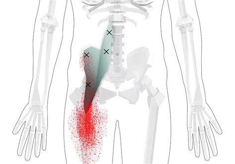 Iliopsoas Trigger Points Overview And Tips For Self Treatment