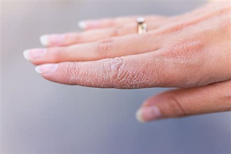 Dry And Cracked Hands Causes And Treatment