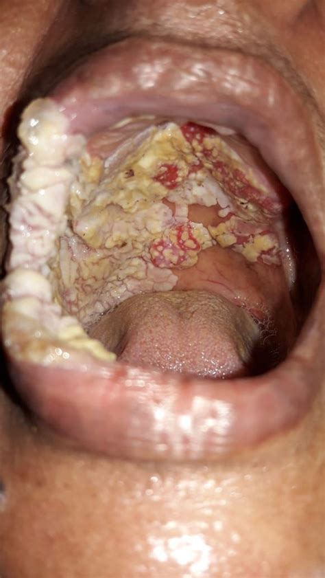 Oral Candidiasis Also Known As Oral Thrush Among Other Free Download Nude Photo Gallery