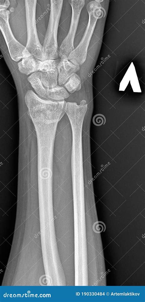 X Rays Of A Broken Arm Human Anatomy Image Of A Bone Injury With