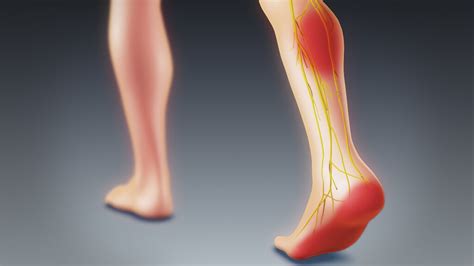Can Sciatica Cause Foot Pain And Swelling Red Mountain Footcare