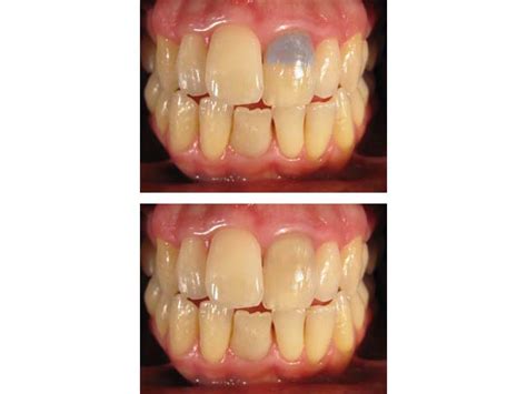 Entfernen sie rote augen, werden sie akne und falten los und weißen sie die zähne! Internes Zahn Bleaching - Dental BlogDental Blog