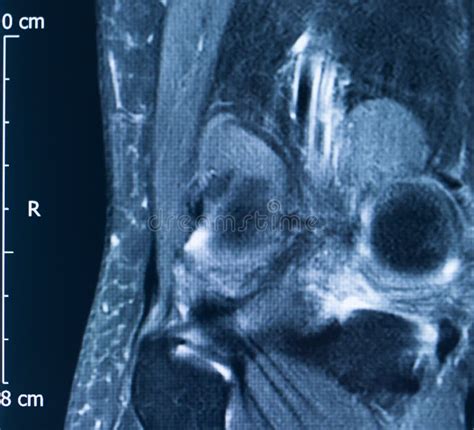 Knee Injury Mri Mcl Tear Stock Image Image Of Anatomy 152269343
