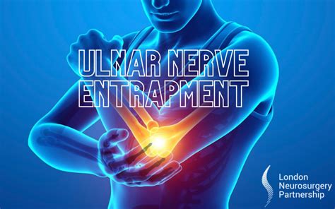 Ulnar Nerve Entrapment Syndrome