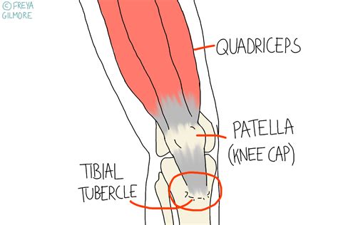 Osgood Schlatter Disease Beth Forrest Osteopathy