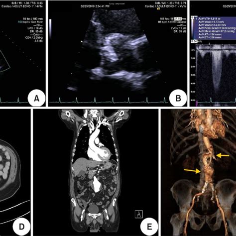 A B Echocardiography Showed Heavily Calcified Aortic Valve With A