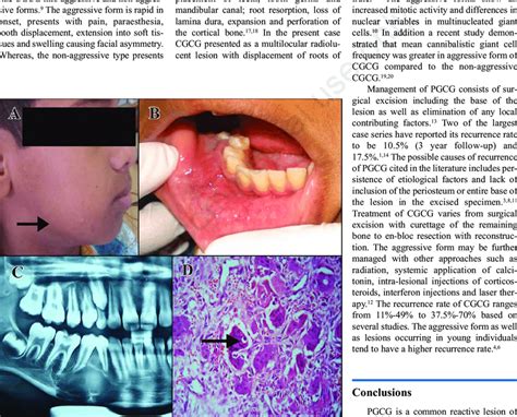 A Extra Oral Photograph Showing Difuse Ill Defined Swelling At The