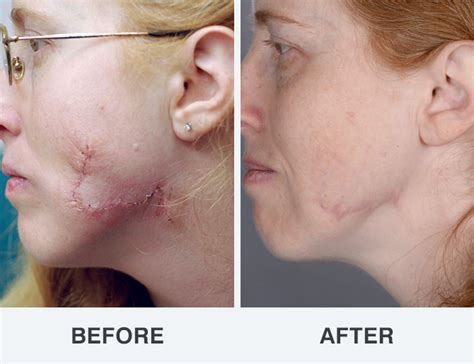 Laser Scar Removal Photos Soderstrom Skin Institute