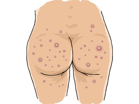 Home Remedies For Acne And Boils On The Buttocks