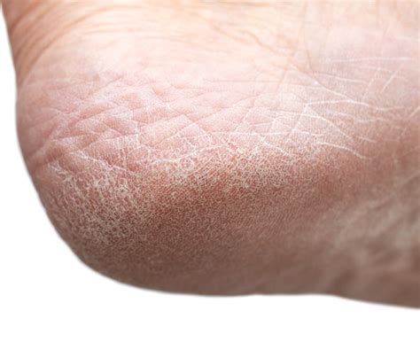 Dry Cracked Skin On The Heels Of The Feet Stock Image Image Of White