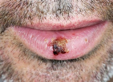 Infected Cold Sore Stock Image C0238933 Science Photo Library