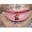 Infected Cold Sore  Stock Image C023/8933 Science Photo Library