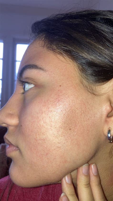 Tiny Bumps Rash On Cheek Beauty Insider Community