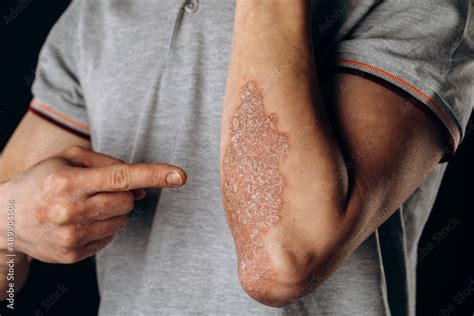 Acute Psoriasis On The Elbows Is An Autoimmune Incurable Dermatological