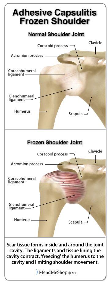 Shoulder Bursitis Bursitis Of The Shoulder Frozen Shoulder