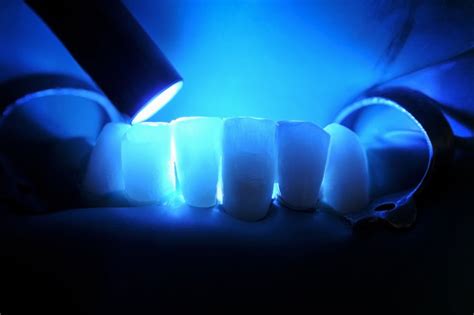 Painless Dental Lasers Can Render Teeth Cavity Resistant University
