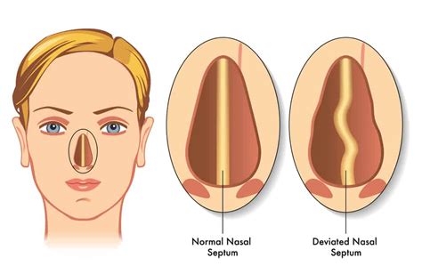 Septorhinoplasty Everything You Need To Know About This Nose Surgery About This Nose Surgery