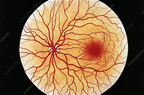 Retina And Blood Vessels Stock Image P4240163 Science Photo Library
