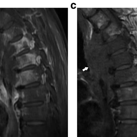 A Postcontrast Axial T1 Weighted Mri With Fat Suppression Reveals An