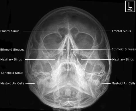 Sinuses Radiographic Anatomy WikiRadiography