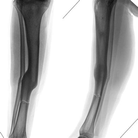 Ap And Lat Radiographs Of The Tibia 6 Months After Frame Removal 1