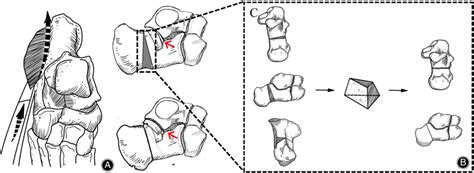 Diagram Showing The Main Osteotomies Performed In The Reconstructive