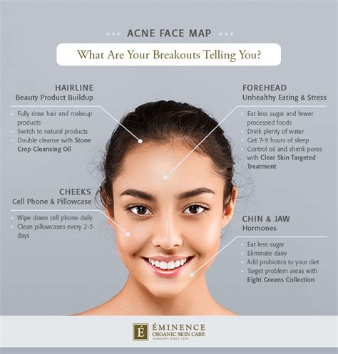 Your hormones are out of whack. Acne Face Map: What Are Your Breakouts Telling You ...
