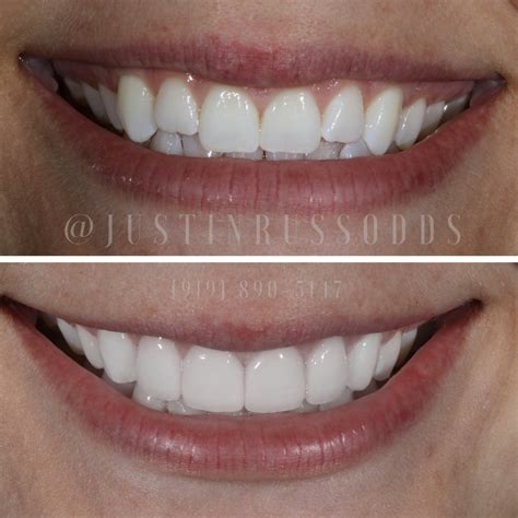 Cosmetic Dentistry Raleigh Nc Teeth Whitening Veneers Dental Implants