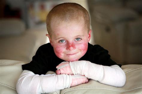 Rare Skin Condition Causes Little Boys Skin To Fall Off At Slightest