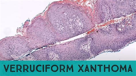 Verruciform Xanthoma Looks Like A Wart On Fire With Foamy Cells In