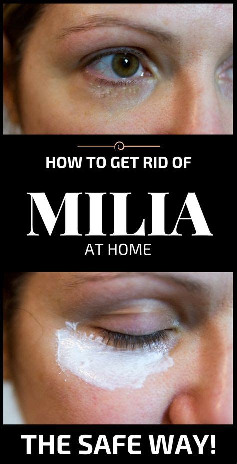 How To Get Rid Of Milia At Home The Safe Way