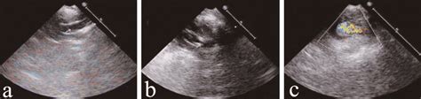 Representative Ultrasound Images Show Aortic Dilatation A The Normal