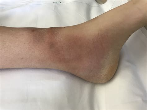 Inflammation The Foot And Ankle Online Journal