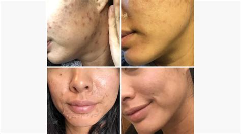 What To Know About Chemical Peel Vi Cosmetic Surgery Tips