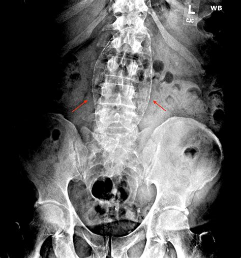 Cureus Massive Calcified Abdominal Aortic Aneurysm Presenting As Low Back Pain