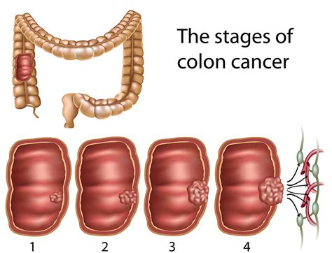 Risk Factors For Colon Cancer Colon Cancer Treatment In India
