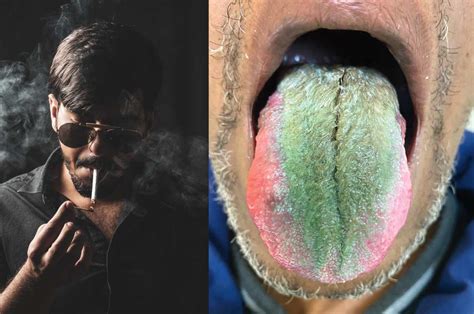 Watch Man Develops Green Hairy Tongue Due To Smoking Addiction