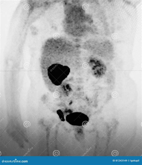 Ct Scan Liver Mass Oncological Pathology Stock Image Image Of
