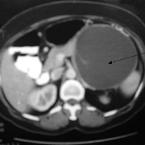 Axial Ct Image Shows A Large Cystic Lesion In The Tail Of The Pancreas
