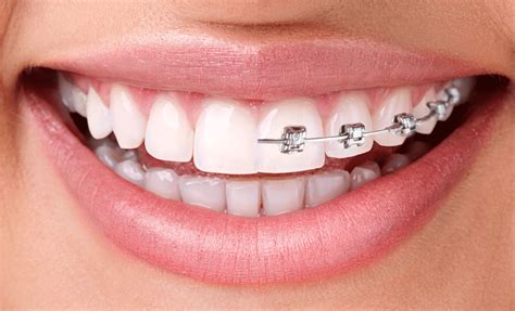Braces & Invisalign | Dental Laser Esthetics