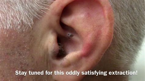 Ear Blackhead Extraction Dr Steven Greene In Seattle Youtube