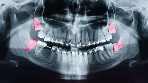 Gary hunter updated aug 12, 2021. Wisdom Teeth Removal in Birmingham | Buck and Phillips
