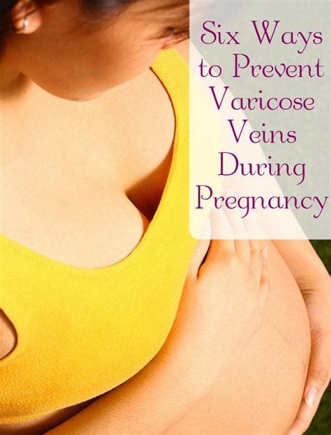 6 Ways To Prevent Varicose Veins During Pregnancy
