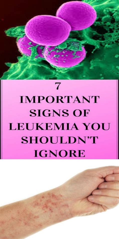 7 Important Signs Of Leukemia You Shouldnt Ignore Healthy Team
